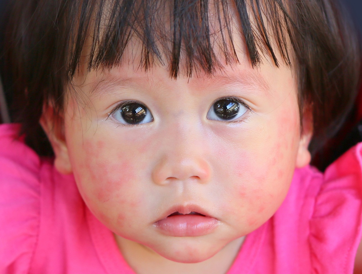 Bingung Alergi Anak Tidak Kunjung sembuh? Ini Penyebab, Gejala dan Solusinya